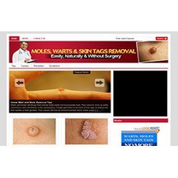 Moles and Warts WP Niche Theme – Free PLR Website